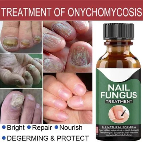 Fast Nail Fungal Treatments Nail Repair Essences Serum Care Treatments Foot Nail Fungus Removal Gel